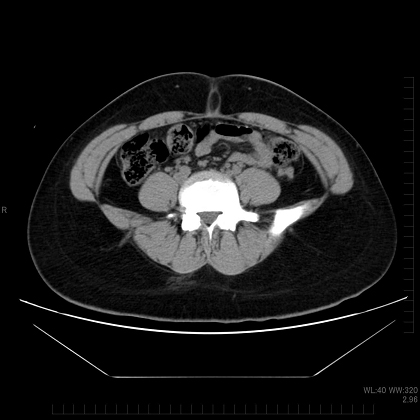 皮下脂肪型肥満